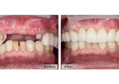 Smile Gallery - Smile Makers Dentist - Baltimore, MD