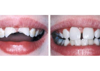 Smile Gallery - Smile Makers Dentist - Baltimore, MD