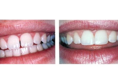 Smile Gallery - Smile Makers Dentist - Baltimore, MD