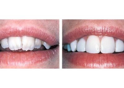 Smile Gallery - Smile Makers Dentist - Baltimore, MD