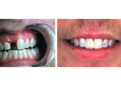 Smile Gallery - Smile Makers Dentist - Baltimore, MD