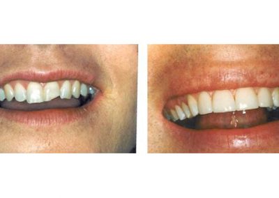 Smile Gallery - Smile Makers Dentist - Baltimore, MD