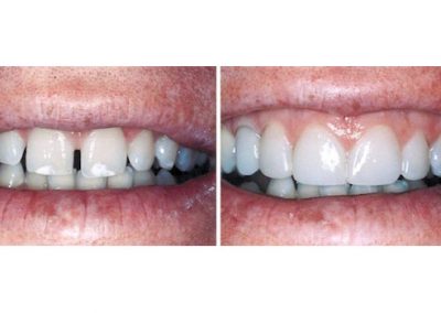 Smile Gallery - Smile Makers Dentist - Baltimore, MD