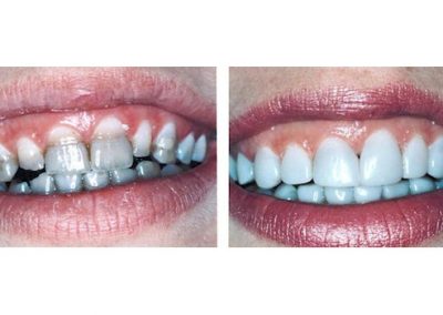 Smile Gallery - Smile Makers Dentist - Baltimore, MD