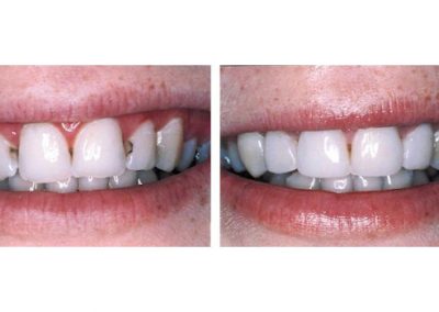 Smile Gallery - Smile Makers Dentist - Baltimore, MD