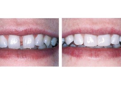 Smile Gallery - Smile Makers Dentist - Baltimore, MD