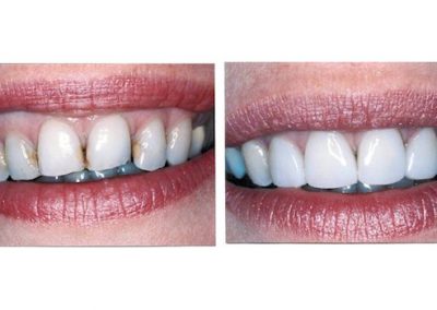 Smile Gallery - Smile Makers Dentist - Baltimore, MD