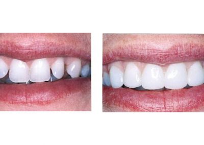 Smile Gallery - Smile Makers Dentist - Baltimore, MD