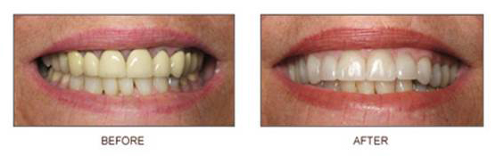 crowns1 Crowns - Before & After - Smile Makers Dentist in Bel Air, MD