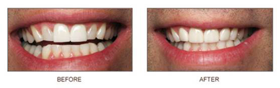 crowns2 Crowns - Before & After - Smile Makers Dentist in Bel Air, MD