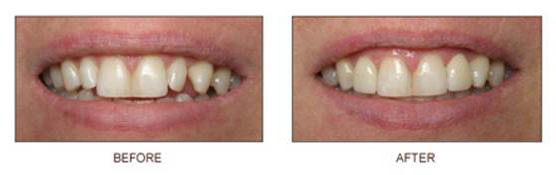 crowns3 Crowns - Before & After - Smile Makers Dentist in Bel Air, MD